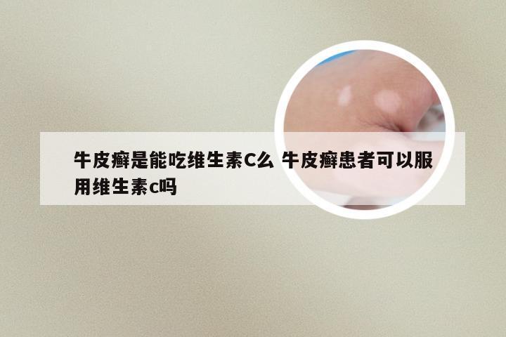 牛皮癣是能吃维生素C么 牛皮癣患者可以服用维生素c吗