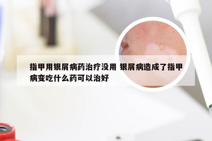 指甲用银屑病药治疗没用 银屑病造成了指甲病变吃什么药可以治好
