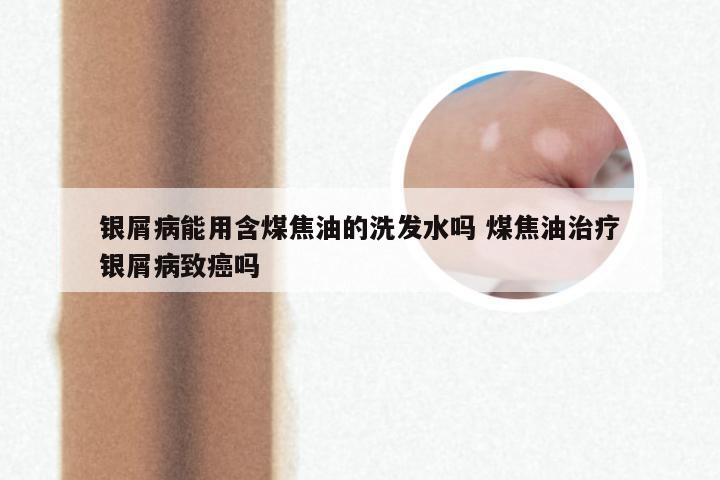 银屑病能用含煤焦油的洗发水吗 煤焦油治疗银屑病致癌吗