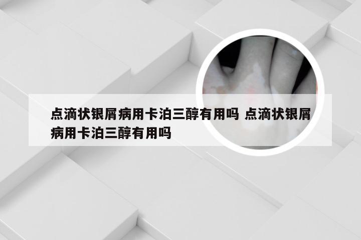 点滴状银屑病用卡泊三醇有用吗 点滴状银屑病用卡泊三醇有用吗