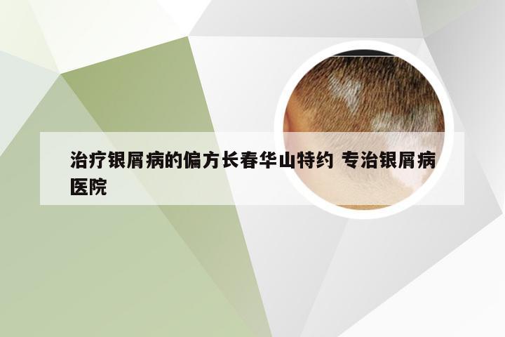 治疗银屑病的偏方长春华山特约 专治银屑病医院