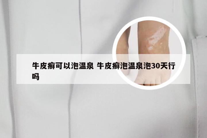 牛皮癣可以泡温泉 牛皮癣泡温泉泡30天行吗
