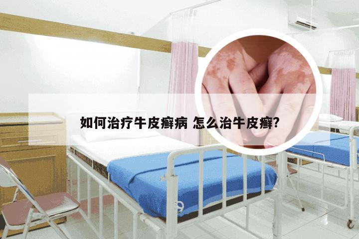 如何治疗牛皮癣病 怎么治牛皮癣?