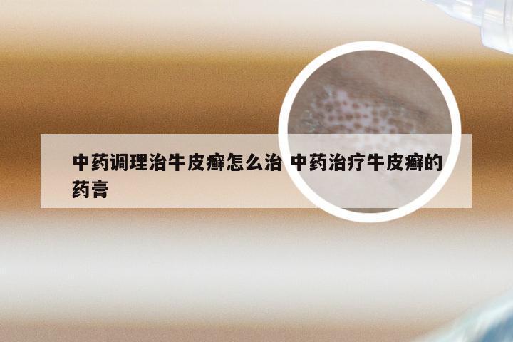 中药调理治牛皮癣怎么治 中药治疗牛皮癣的药膏
