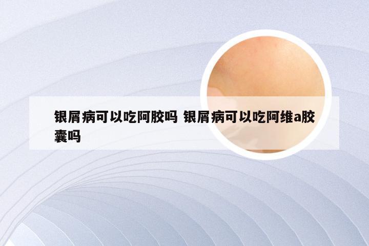 银屑病可以吃阿胶吗 银屑病可以吃阿维a胶囊吗