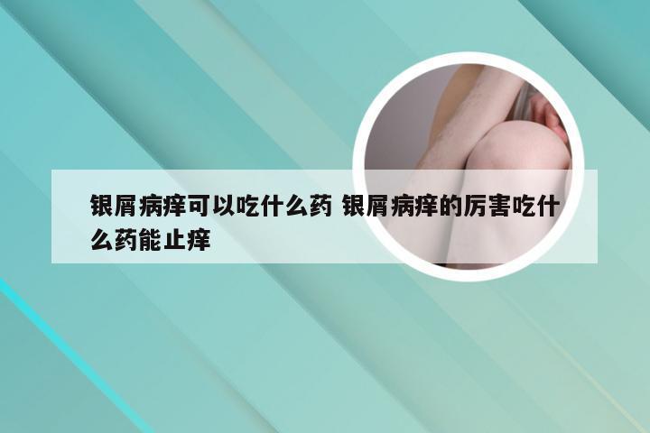 银屑病痒可以吃什么药 银屑病痒的厉害吃什么药能止痒