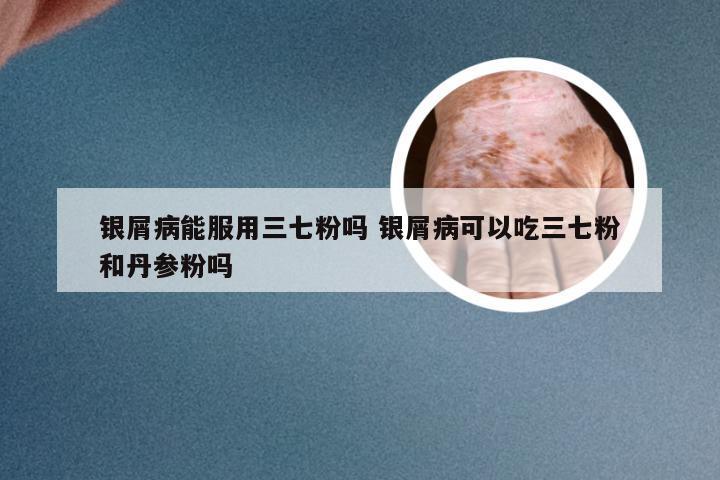 银屑病能服用三七粉吗 银屑病可以吃三七粉和丹参粉吗