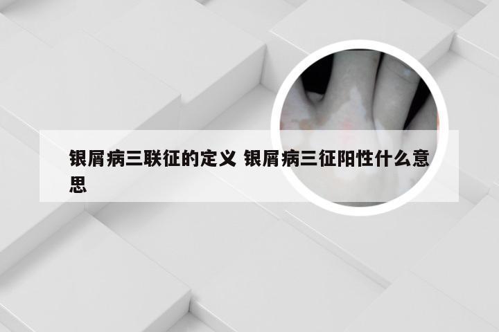 银屑病三联征的定义 银屑病三征阳性什么意思