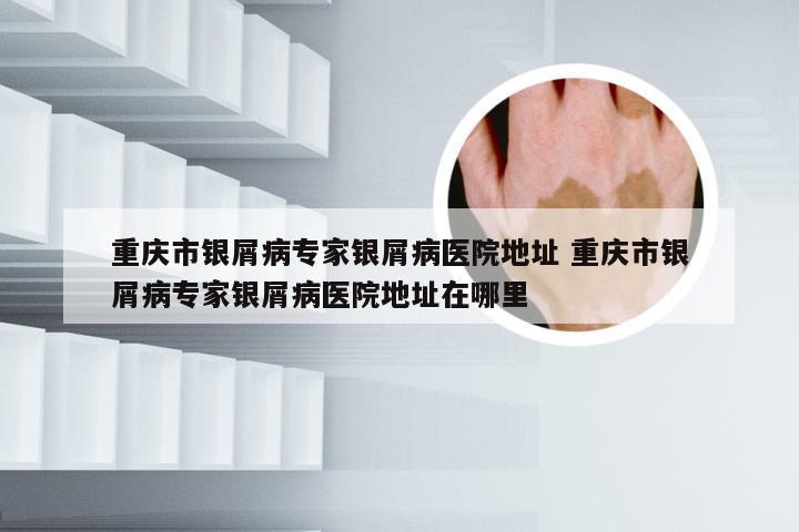 重庆市银屑病专家银屑病医院地址 重庆市银屑病专家银屑病医院地址在哪里