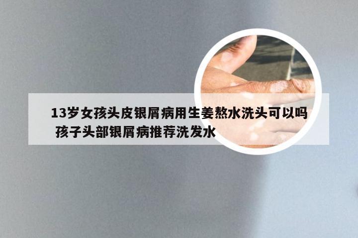 13岁女孩头皮银屑病用生姜熬水洗头可以吗 孩子头部银屑病推荐洗发水