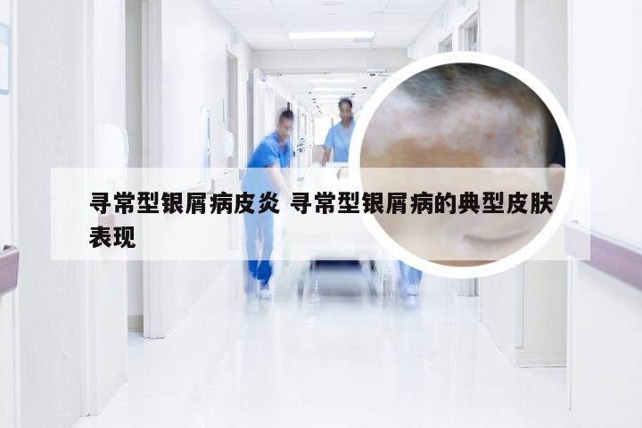 寻常型银屑病皮炎 寻常型银屑病的典型皮肤表现