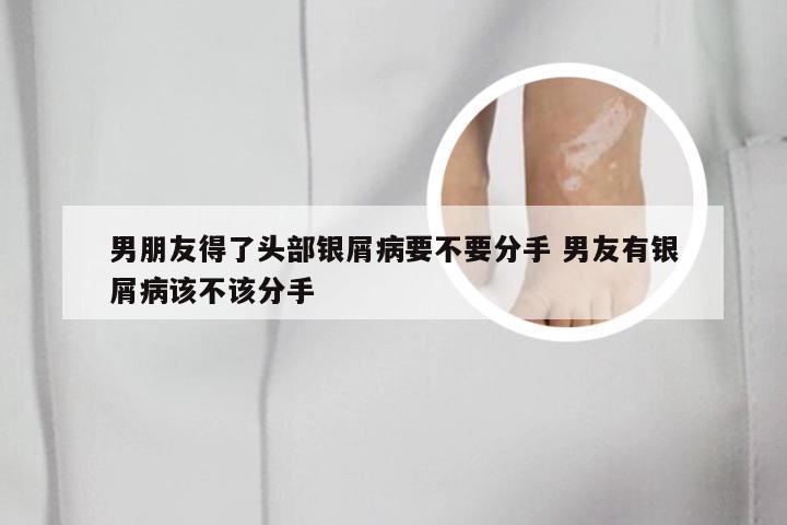 男朋友得了头部银屑病要不要分手 男友有银屑病该不该分手