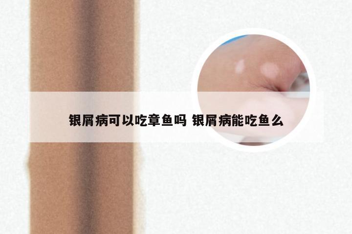 银屑病可以吃章鱼吗 银屑病能吃鱼么
