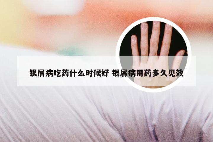 银屑病吃药什么时候好 银屑病用药多久见效