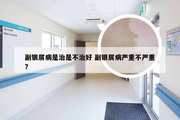 副银屑病是治是不治好 副银屑病严重不严重?