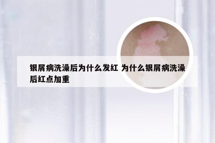 银屑病洗澡后为什么发红 为什么银屑病洗澡后红点加重
