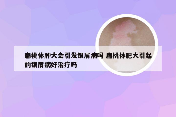 扁桃体肿大会引发银屑病吗 扁桃体肥大引起的银屑病好治疗吗