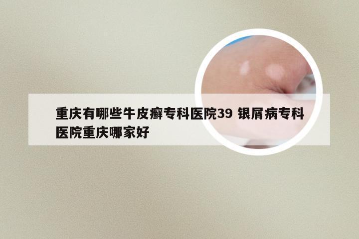 重庆有哪些牛皮癣专科医院39 银屑病专科医院重庆哪家好