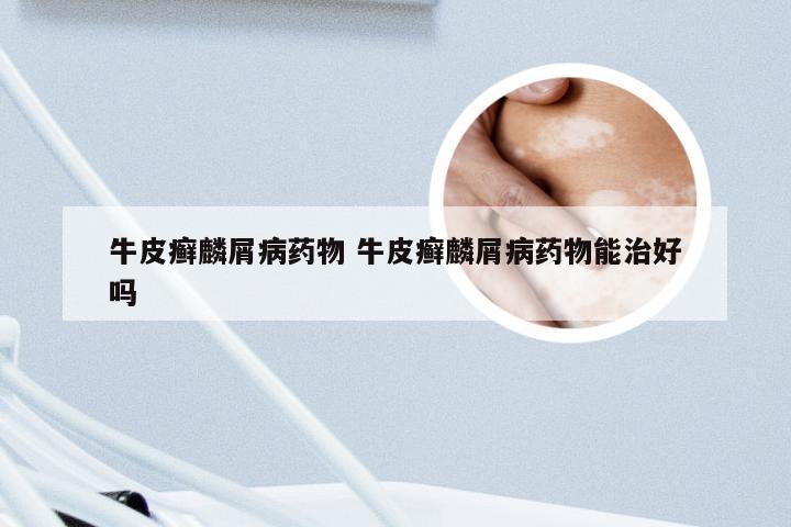 牛皮癣麟屑病药物 牛皮癣麟屑病药物能治好吗