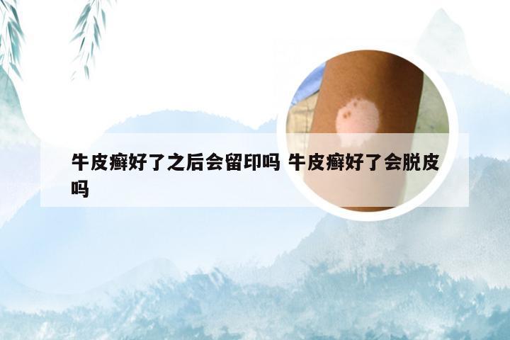 牛皮癣好了之后会留印吗 牛皮癣好了会脱皮吗