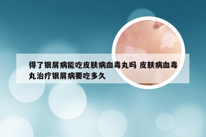 得了银屑病能吃皮肤病血毒丸吗 皮肤病血毒丸治疗银屑病要吃多久