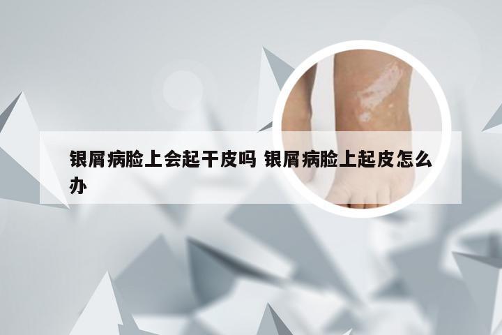 银屑病脸上会起干皮吗 银屑病脸上起皮怎么办