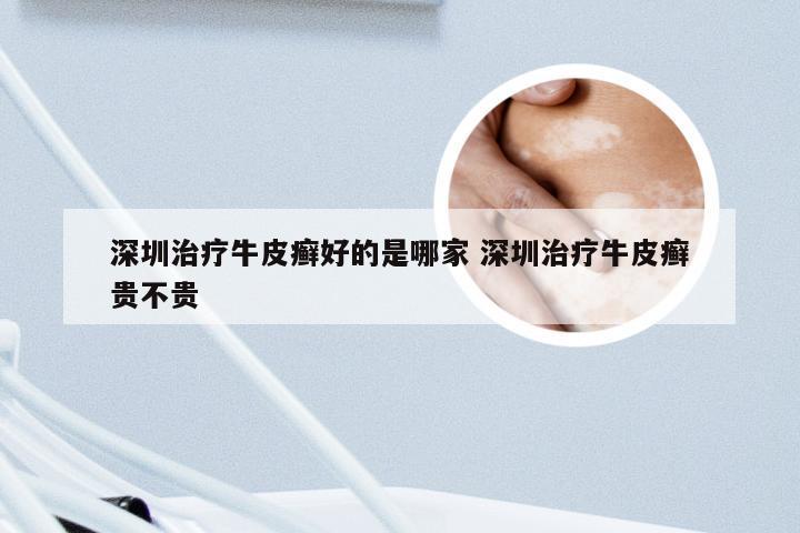 深圳治疗牛皮癣好的是哪家 深圳治疗牛皮癣贵不贵