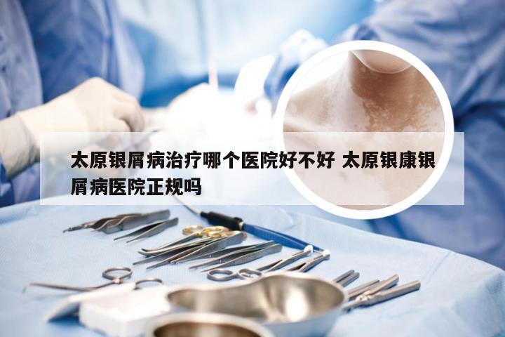 太原银屑病治疗哪个医院好不好 太原银康银屑病医院正规吗
