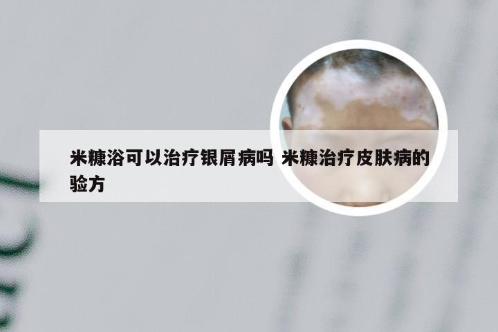 米糠浴可以治疗银屑病吗 米糠治疗皮肤病的验方