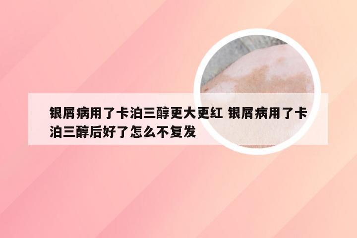银屑病用了卡泊三醇更大更红 银屑病用了卡泊三醇后好了怎么不复发