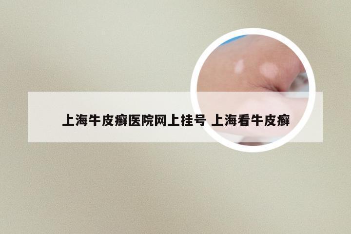 上海牛皮癣医院网上挂号 上海看牛皮癣