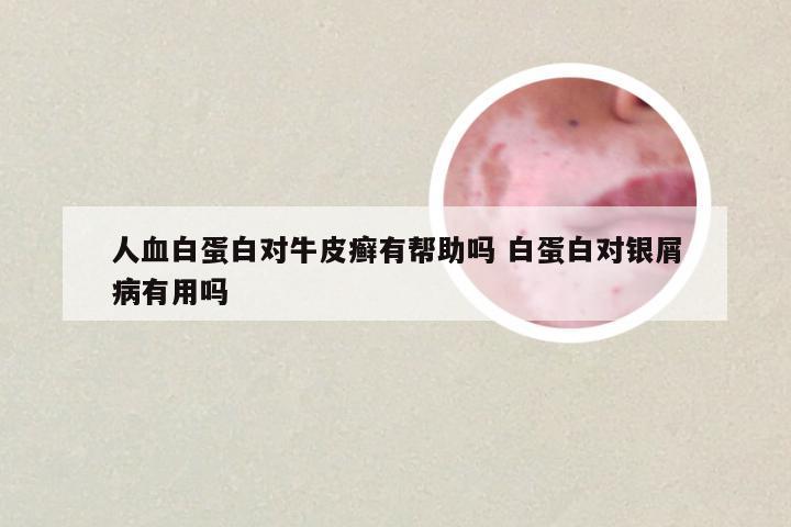 人血白蛋白对牛皮癣有帮助吗 白蛋白对银屑病有用吗
