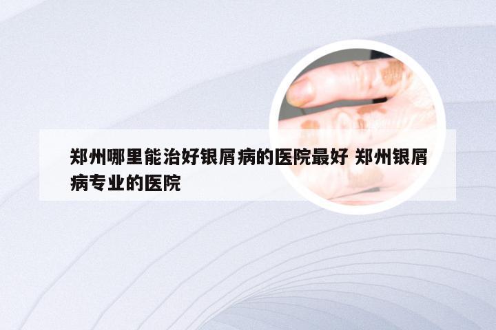 郑州哪里能治好银屑病的医院最好 郑州银屑病专业的医院