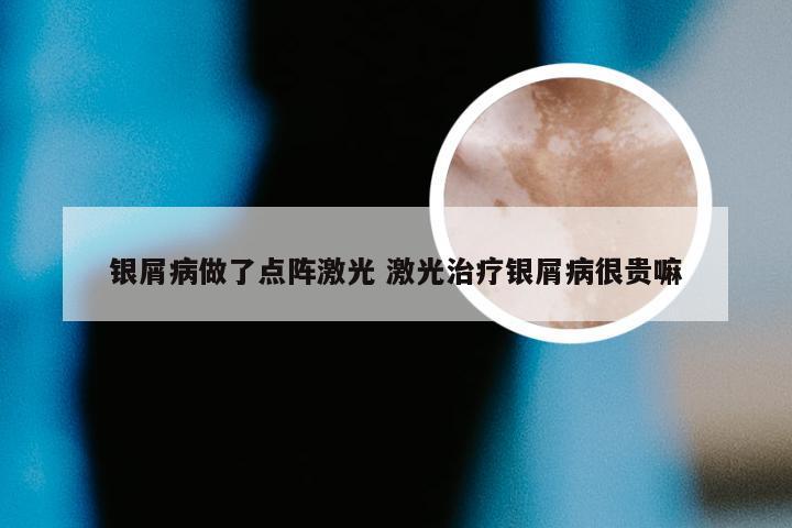银屑病做了点阵激光 激光治疗银屑病很贵嘛