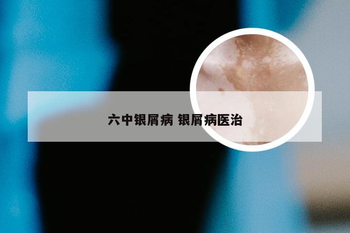 六中银屑病 银屑病医治