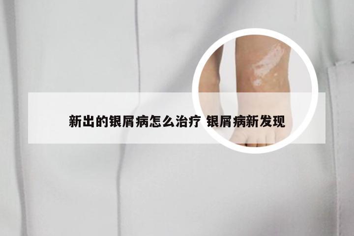新出的银屑病怎么治疗 银屑病新发现