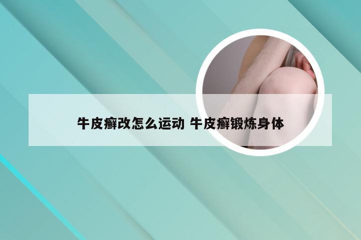 牛皮癣改怎么运动 牛皮癣锻炼身体