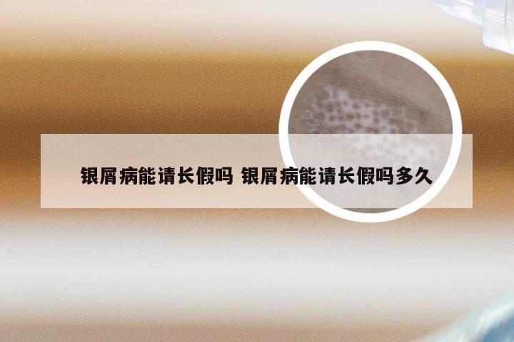 银屑病能请长假吗 银屑病能请长假吗多久