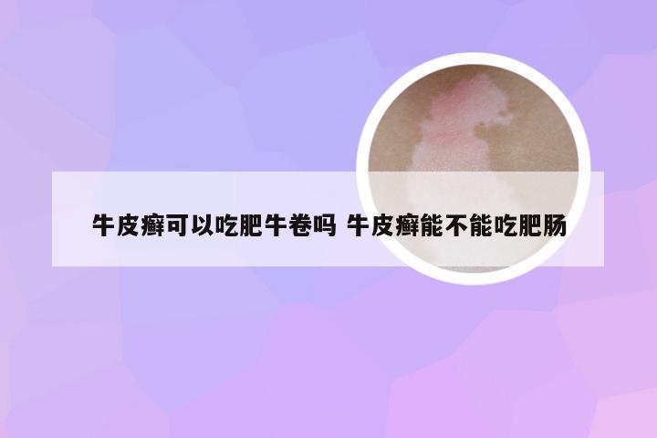 牛皮癣可以吃肥牛卷吗 牛皮癣能不能吃肥肠