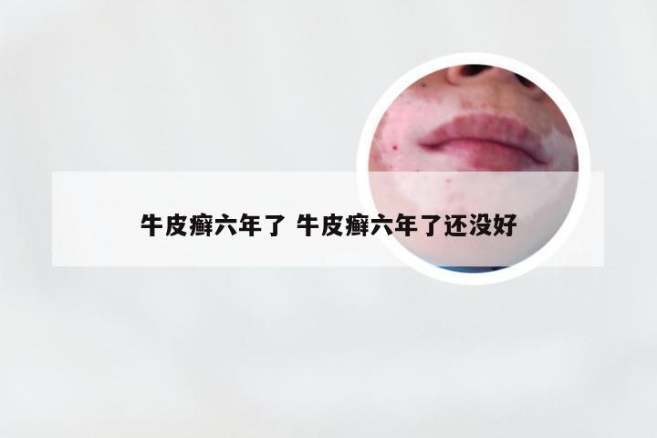 牛皮癣六年了 牛皮癣六年了还没好