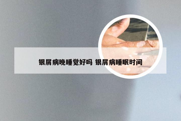 银屑病晚睡觉好吗 银屑病睡眠时间