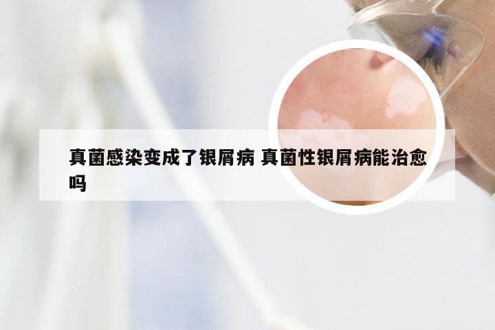 真菌感染变成了银屑病 真菌性银屑病能治愈吗