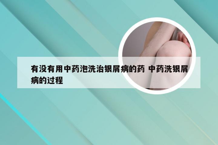 有没有用中药泡洗治银屑病的药 中药洗银屑病的过程