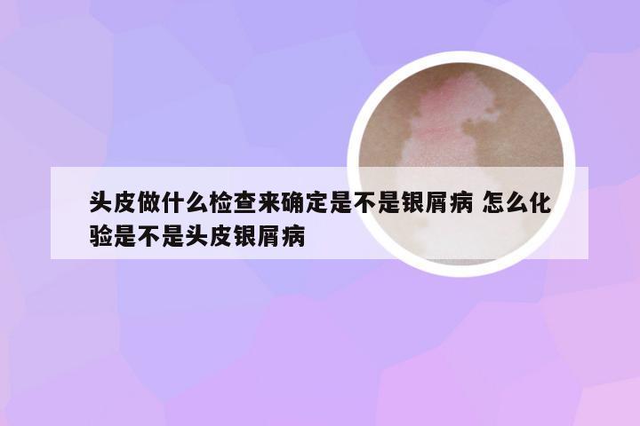 头皮做什么检查来确定是不是银屑病 怎么化验是不是头皮银屑病