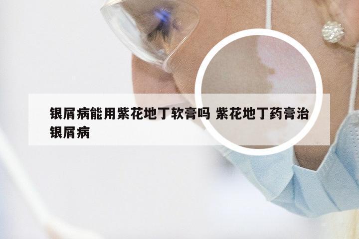 银屑病能用紫花地丁软膏吗 紫花地丁药膏治银屑病
