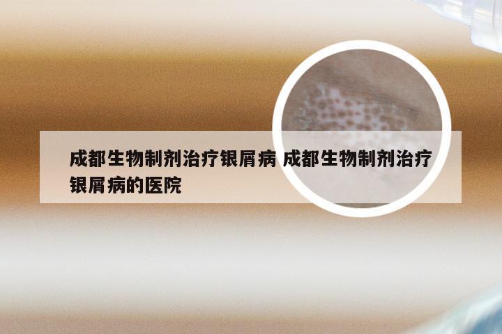 成都生物制剂治疗银屑病 成都生物制剂治疗银屑病的医院