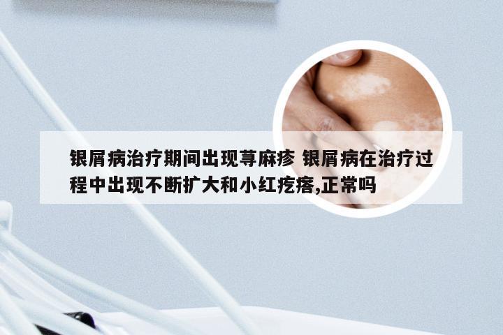 银屑病治疗期间出现荨麻疹 银屑病在治疗过程中出现不断扩大和小红疙瘩,正常吗