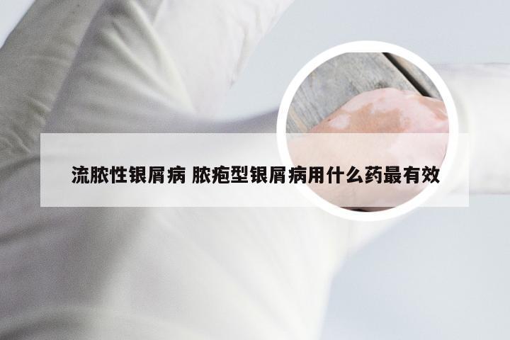 流脓性银屑病 脓疱型银屑病用什么药最有效