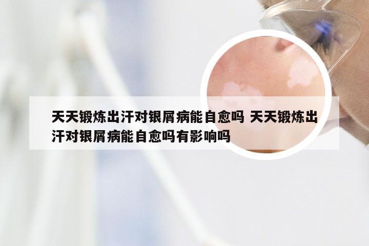天天锻炼出汗对银屑病能自愈吗 天天锻炼出汗对银屑病能自愈吗有影响吗