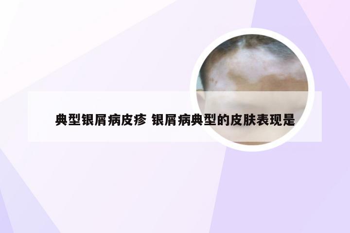 典型银屑病皮疹 银屑病典型的皮肤表现是